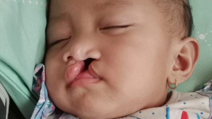 Balita Khalisa Masih Perlu 3 Kali Operasi Bibir Sumbing, Ayo Bantu - Update 1