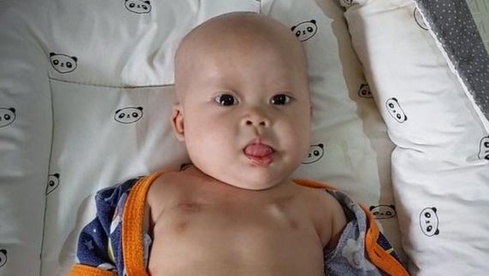 **”Kisah Chiara: Bayi 8 Bulan Berjuang melawan Tumor Teratoma Immature, Harapan untuk Sembuh”**